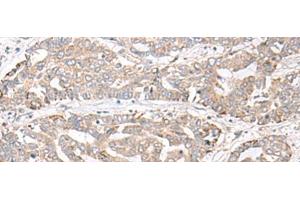 Immunohistochemistry of paraffin-embedded Human liver cancer tissue using CHST4 Polyclonal Antibody at dilution of 1:35(x200) (CHST4 anticorps)