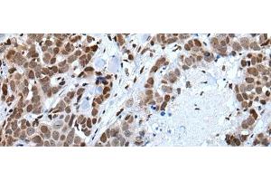 Immunohistochemistry of paraffin-embedded Human thyroid cancer tissue using CELF5 Polyclonal Antibody at dilution of 1:65(x200) (CELF5 anticorps)