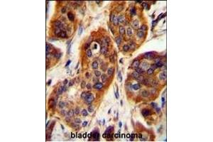 LRRC57 Antibody (C-term) (ABIN654494 and ABIN2844226) immunohistochemistry analysis in formalin fixed and paraffin embedded human bladder carcinoma followed by peroxidase conjugation of the secondary antibody and DAB staining.
