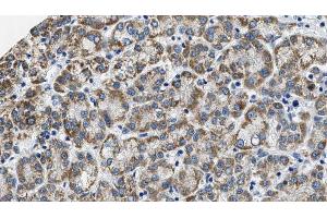 ABIN6274573 at 1/100 staining Human liver cancer tissue by IHC-P. (HTR2C anticorps  (Internal Region))