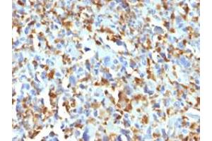 Immunohistochemical staining (Formalin-fixed paraffin-embedded sections) of human histiocytoma with F13A1 monoclonal antibody, clone F13A1/1683 . (F13A1 anticorps  (AA 46-181))