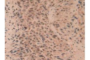 Detection of RORg in Human Lung Cancer Tissue using Polyclonal Antibody to RAR Related Orphan Receptor Gamma (RORg)