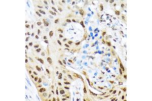Immunohistochemistry of paraffin-embedded human lung cancer using HES5 Rabbit mAb (ABIN7267559) at dilution of 1:100 (40x lens). (HES5 anticorps)