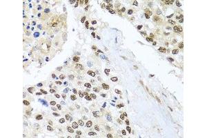 Immunohistochemistry of paraffin-embedded Human lung cancer using BNIP3L Polyclonal Antibody at dilution of 1:100 (40x lens). (BNIP3L/NIX anticorps)