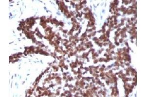 Formalin-fixed, paraffin-embedded human ovarian carcinoma stained with Cyclin B1 antibody. (Cyclin B1 anticorps)