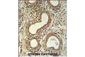 Roundabout 4 Antibody (N-term) (ABIN651292 and ABIN2840173) IHC analysis in formalin fixed and paraffin embedded prostate carcinoma followed by peroxidase conjugation of the secondary antibody and DAB staining.