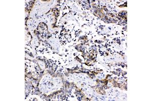 Anti-MRP1 antibody, IHC(P) IHC(P): Human Lung Cancer Tissue (ABCC1 anticorps  (C-Term))