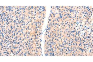 Immunohistochemistry of paraffin-embedded Human liver cancer using PAFAH2 Polyclonal Antibody at dilution of 1:80 (PAFAH2 anticorps)