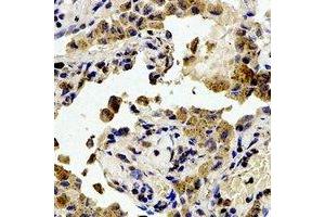 Immunohistochemical analysis of Focal Adhesion Kinase (pY407) staining in human lung cancer formalin fixed paraffin embedded tissue section.