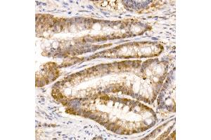 Immunohistochemistry of paraffin-embedded human colon carcinoma using Bag1 Rabbit mAb (ABIN7265847) at dilution of 1:50 (40x lens). (BAG1 anticorps)