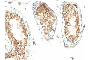 Formalin-fixed, paraffin-embedded human Testicular Carcinoma stained with ODC-1 Mouse Monoclonal Antibody (ODC1/485).