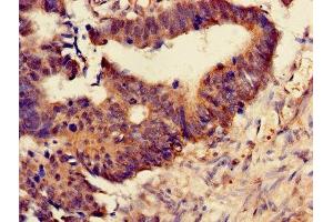 Immunohistochemistry of paraffin-embedded human colon cancer using ABIN7164978 at dilution of 1:100