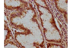 IHC image of ABIN7175232 diluted at 1:100 and staining in paraffin-embedded human gastric cancer performed on a Leica BondTM system.