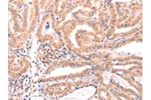 The image on the left is immunohistochemistry of paraffin-embedded Human thyroid cancer tissue using ABIN7129152(DAZ4 Antibody) at dilution 1/50, on the right is treated with fusion protein.