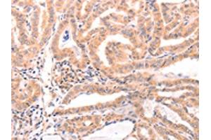 The image on the left is immunohistochemistry of paraffin-embedded Human thyroid cancer tissue using ABIN7129152(DAZ4 Antibody) at dilution 1/50, on the right is treated with fusion protein. (DAZ4 anticorps)