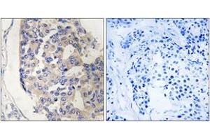 Immunohistochemistry analysis of paraffin-embedded human breast carcinoma tissue, using C1S Antibody. (C1S anticorps  (AA 541-590))