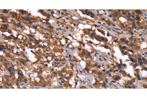 Immunohistochemistry of paraffin-embedded Human thyroid cancer tissue using GREB1 Polyclonal Antibody at dilution 1:40 (GREB1 anticorps)