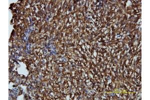 Immunoperoxidase of monoclonal antibody to LDLRAP1 on formalin-fixed paraffin-embedded human maligant fibrous histiocytoma tissue.