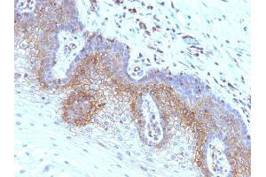 Formalin-fixed, paraffin-embedded human Cervical Carcinoma stained with Beta-2-Microglobulin Monoclonal Antibody (SPM617)