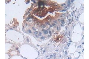 Detection of DEFa3 in Human Colorectal cancer Tissue using Polyclonal Antibody to Defensin Alpha 3, Neutrophil Specific (DEFa3)
