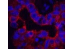 Immunofluorescence analysis of Human liver cancer tissue using CK-16 Monoclonal Antibody at dilution of 1:200.