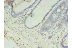 Immunohistochemistry of paraffin-embedded human colon cancer using ABIN7148128 at dilution of 1:100