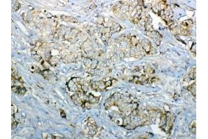 IHC testing of FFPE human breast cancer tissue with GALNS antibody at 1ug/ml. (GALNS anticorps)