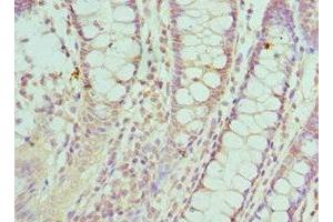 Immunohistochemistry of paraffin-embedded human colon cancer using ABIN7170857 at dilution of 1:100 (SMC1A anticorps  (AA 1-130))