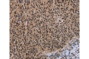 Immunohistochemistry of Human thyroid cancer using DLX4 Polyclonal Antibody at dilution of 1:50 (DLX4 anticorps)