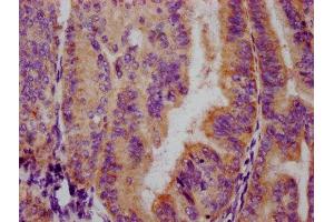 IHC image of ABIN7127694 diluted at 1:100 and staining in paraffin-embedded human endometrial cancer performed on a Leica BondTM system. (Recombinant FOXO3 anticorps  (pSer253))