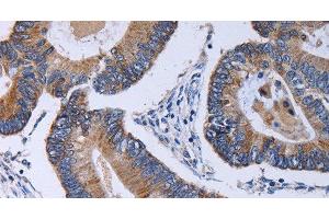 Immunohistochemistry of paraffin-embedded Human colon cancer using CA4 Polyclonal Antibody at dilution of 1:30 (CA4 anticorps)