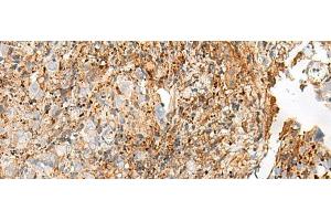 Immunohistochemistry of paraffin-embedded Human cervical cancer tissue using GPR27 Polyclonal Antibody at dilution of 1:25(x200)