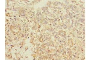 Immunohistochemistry of paraffin-embedded human pancreatic cancer using ABIN7172196 at dilution of 1:100 (TIGD7 anticorps  (AA 1-300))