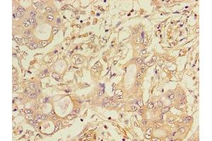 Immunohistochemistry of paraffin-embedded human pancreatic cancer using ABIN7158780 at dilution of 1:100 (CTSA anticorps  (AA 30-327))