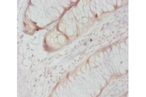 Immunohistochemistry of paraffin-embedded human colon cancer using ABIN7146964 at dilution of 1:20