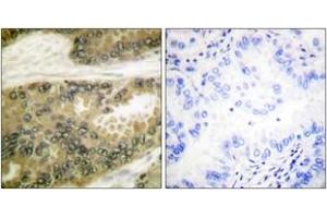 Immunohistochemistry analysis of paraffin-embedded human lung carcinoma tissue, using Cyclin D3 (Ab-283) Antibody.