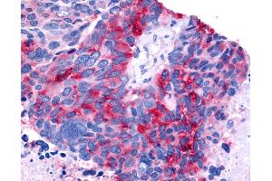 Anti-RORB / ROR Beta antibody IHC of human Lung, Small Cell Carcinoma. (RORB anticorps  (Ligand Binding Domain))