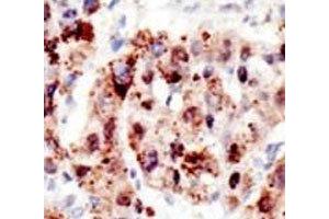 IHC analysis of FFPE human hepatocarcinoma stained with the Ubiquitin antibody