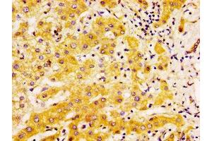 IHC image of ABIN7173899 diluted at 1:500 and staining in paraffin-embedded human liver cancer performed on a Leica BondTM system.