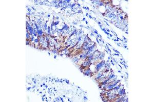 Immunohistochemistry of paraffin-embedded human colon carcinoma using PALLD Rabbit pAb  at dilution of 1:100 (40x lens).