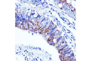 Immunohistochemistry of paraffin-embedded human colon carcinoma using PALLD Rabbit pAb  at dilution of 1:100 (40x lens). (PALLD anticorps  (AA 383-672))