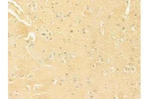 ABIN6263643 and ABIN6277805 at 1/100 staining human glioblastoma by IHC-P. (NCR1 anticorps  (Internal Region))