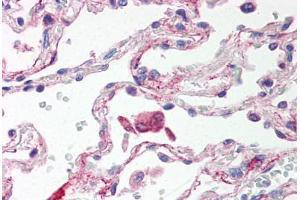 Human Lung, Alveolar Macrophages (formalin-fixed, paraffin-embedded) stained with TLR6 antibody ABIN214529 at 5 ug/ml followed by biotinylated goat anti-rabbit IgG secondary antibody ABIN481713, alkaline phosphatase-streptavidin and chromogen. (TLR6 anticorps  (Internal Region))