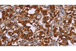 Immunohistochemistry of paraffin-embedded Human thyroid cancer tissue using CYP2W1 Polyclonal Antibody at dilution 1:60 (CYP2W1 anticorps)