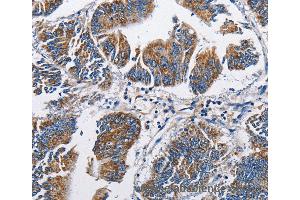 Immunohistochemistry of Human colon cancer using NPPA Polyclonal Antibody at dilution of 1:60 (NPPA anticorps)