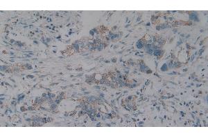 Detection of C1QBP in Human Pancreatic cancer Tissue using Polyclonal Antibody to Complement component 1 Q subcomponent-binding protein, mitochondrial (C1QBP)