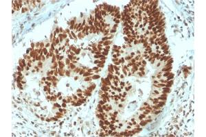 Formalin-fixed, paraffin-embedded human Colon Carcinoma stained with MSH6 Mouse Monoclonal Antibody (MSH6/3091). (MSH6 anticorps  (AA 374-540))