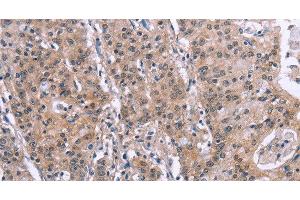 Immunohistochemistry of paraffin-embedded Human gastric cancer tissue using GPR172B Polyclonal Antibody at dilution 1:40 (GPR172B anticorps)