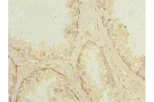 Immunohistochemistry of paraffin-embedded human prostate cancer using ABIN7166868 at dilution of 1:100 (PLPBP anticorps  (AA 1-275))