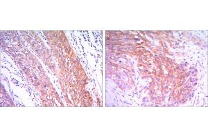 Immunohistochemical analysis of paraffin-embedded esophagus cancer tissues (left) and human lung cancer (right) using HK2 antibody with DAB staining. (Hexokinase 2 anticorps)